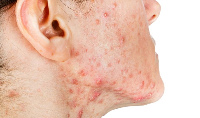 Mụn viêm là tình trạng da liễu phổ biến cần được điều trị đúng cách