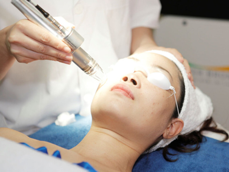 Laser trị sẹo là phương pháp phổ biến