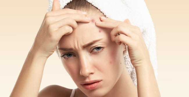 Không nên tự ý nặn mụn để tránh tổn thương và sẹo thâm cho da