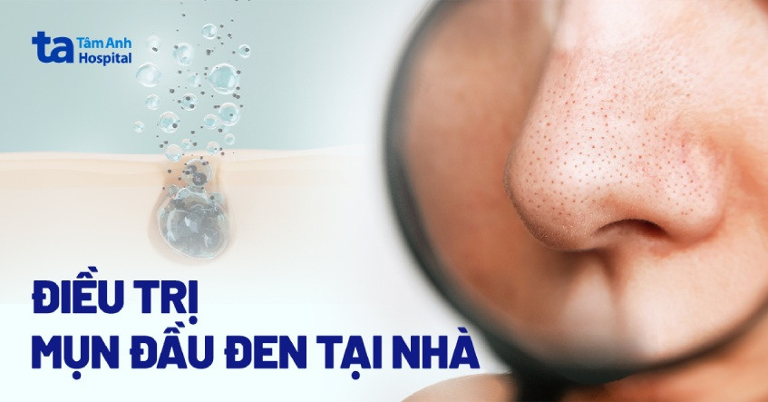 Tổng quan các phương pháp trị mụn đầu đen hiệu quả cho làn da sạch khỏe