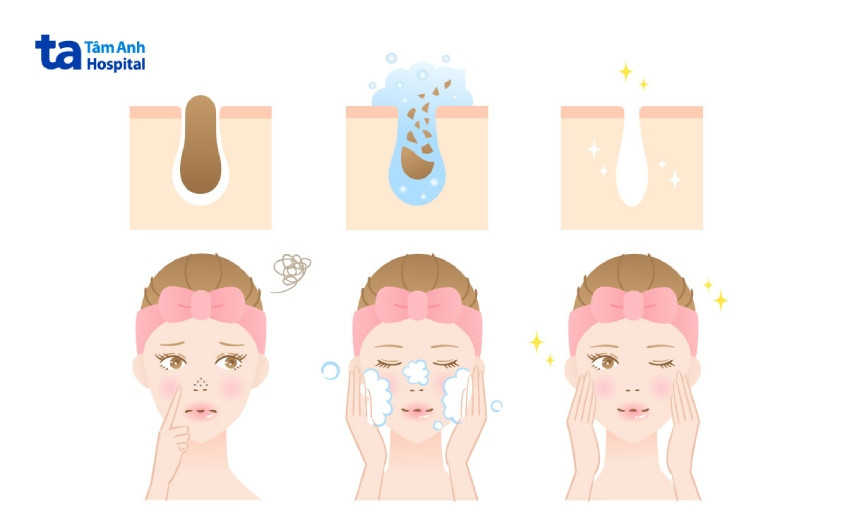 Chăm sóc da đúng cách là bước quan trọng để ngăn ngừa mụn đầu đen tái phát