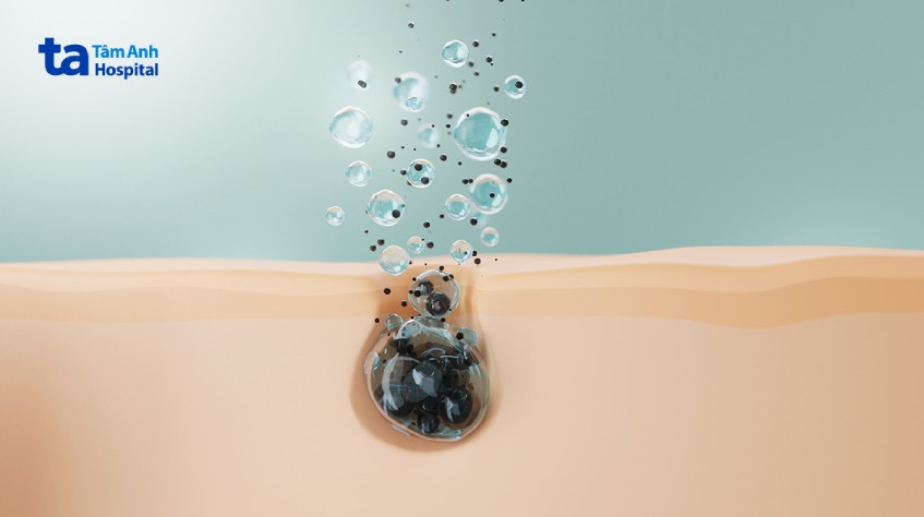 Mụn đầu đen cứng đầu và khó loại bỏ cần phương pháp điều trị chuyên sâu