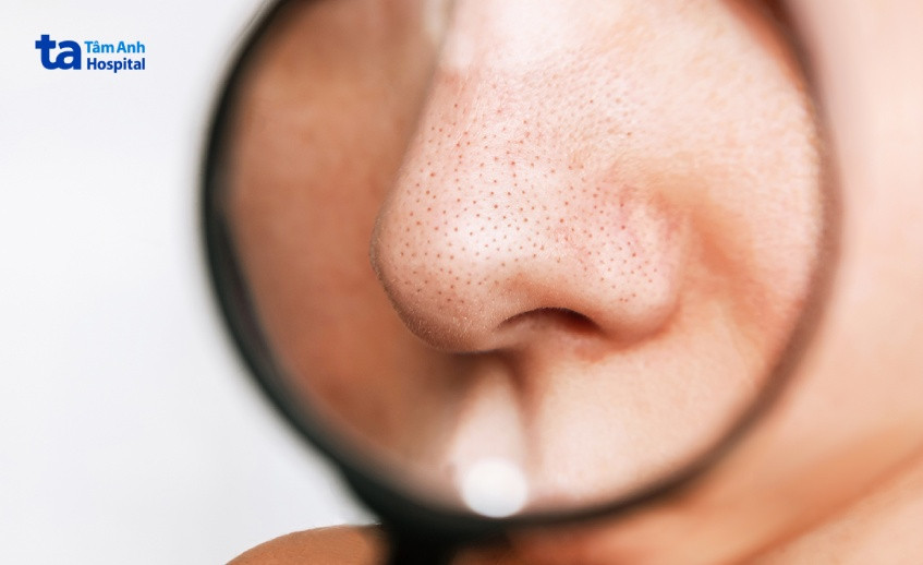 Hình ảnh cận cảnh mụn đầu đen thường xuất hiện ở vùng mũi do bít tắc lỗ chân lông