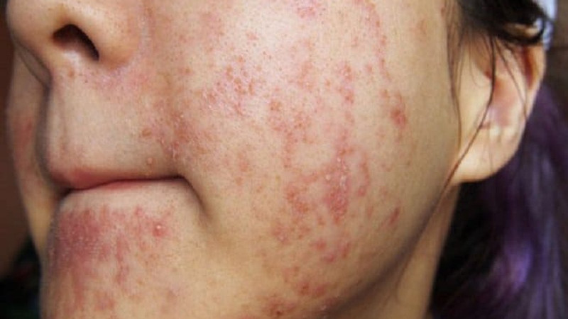 Rượu thuốc trị mụn chứa cồn là một trong những sản phẩm nguy hiểm thường gặp tại các spa kém chất lượng