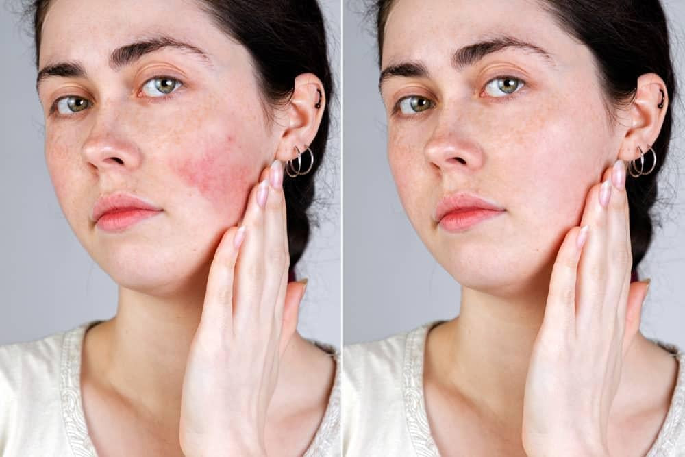 Người phụ nữ thoa serum phục hồi da B5 lên má để chữa lành tổn thương và cấp ẩm