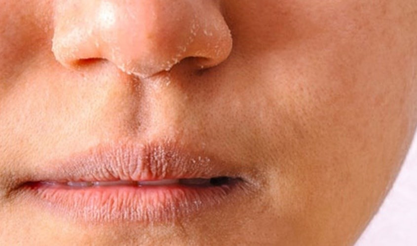 Làn da hỗn hợp đối mặt với thời tiết khô hanh của mùa đông.