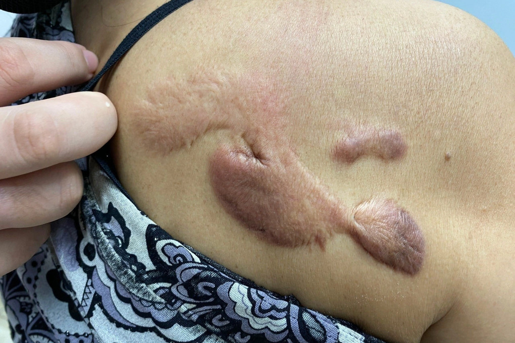 Hình ảnh cận cảnh sẹo lồi lớn trên ngực bệnh nhân trở nên nghiêm trọng hơn sau khi sử dụng dịch vụ trị sẹo tại spa không đúng phương pháp