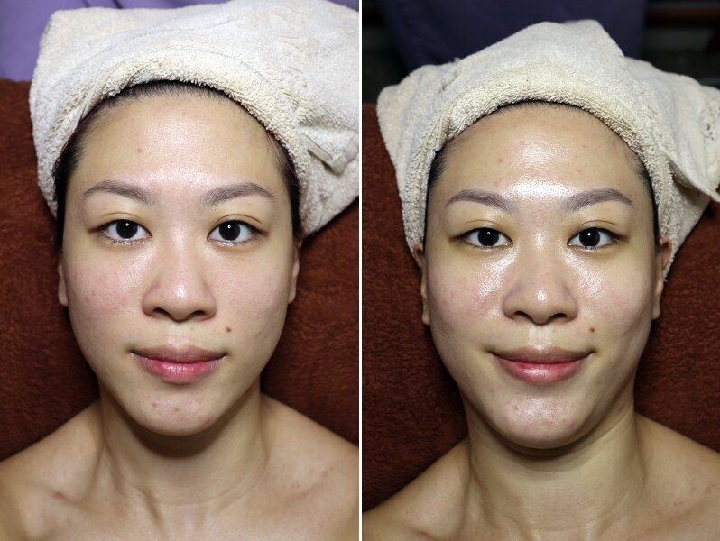 So sánh trước và sau liệu trình Geisha Organic Facial tại Ikeda Spa 787 Bukit Timah Rd, Singapore 269762 cho thấy làn da sáng và mịn màng hơn
