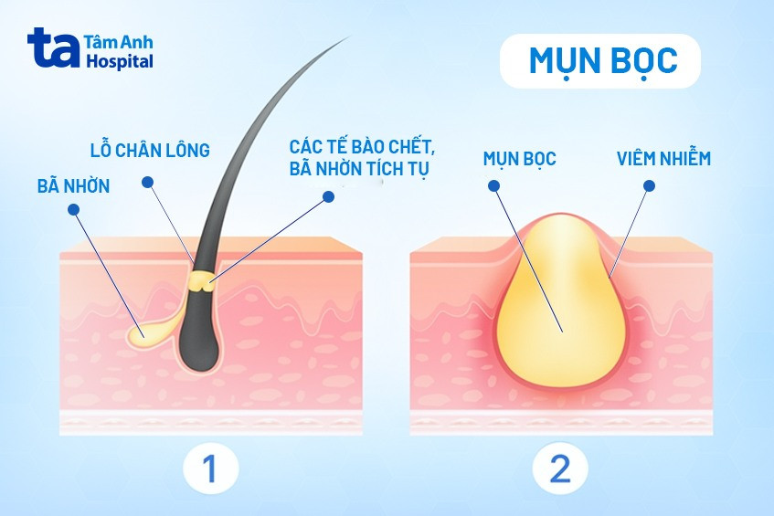 Cơ chế hình thành mụn bọc do bã nhờn gây bít tắc lỗ chân lông