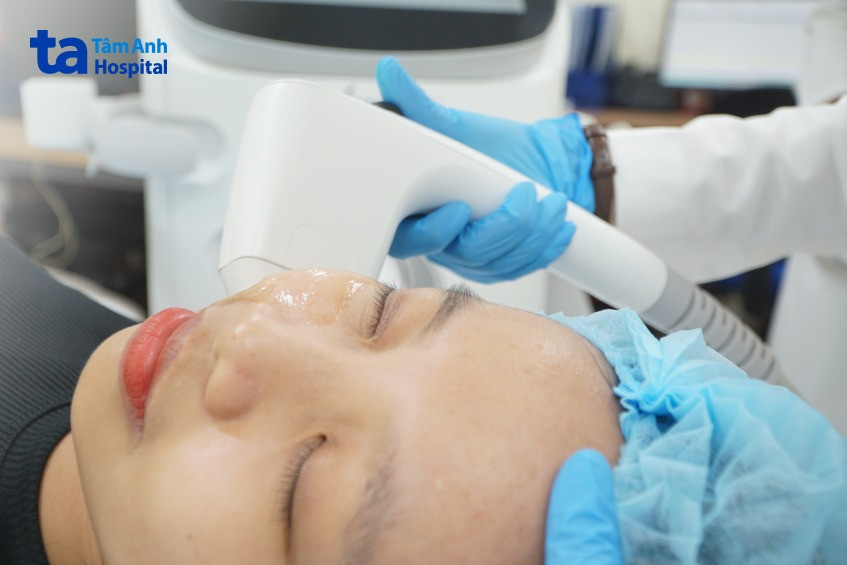 Công nghệ Sofwave™ tại bệnh viện Đa Khoa Tâm Anh TP.HCM giúp làm mờ nếp nhăn hiệu quả