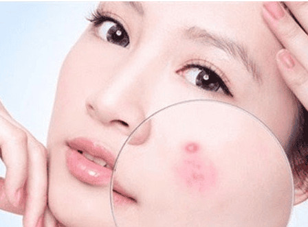 Da khô khiến da tiết ra nhiều dầu hơn gây ra tình trạng mụn trên bề mặt