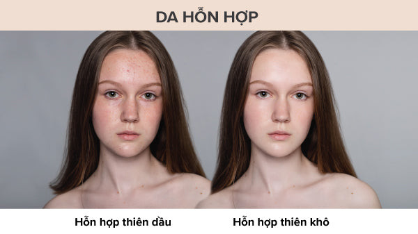 Dấu hiệu nhận biết da hỗn hợp thiên dầu và da hỗn hợp thiên khô qua các vùng trên khuôn mặt