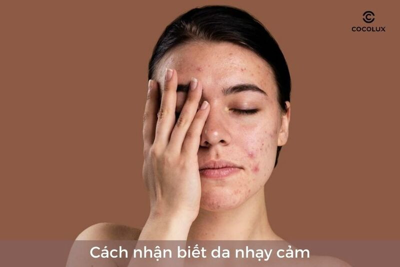 Dấu hiệu nhận biết da nhạy cảm