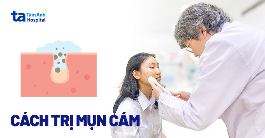 Hình ảnh cận cảnh làn da với mụn cám li ti, minh họa nhu cầu trị mụn cám hiệu quả