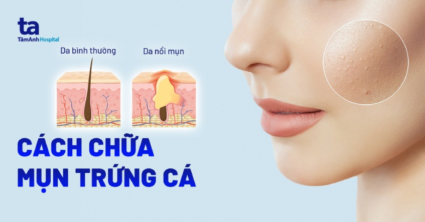 Hình ảnh mụn trứng cá trên da, cho thấy khả năng lây lan nếu không được vệ sinh đúng cách, đặc biệt quan trọng khi trị mụn cho da nhạy cảm.