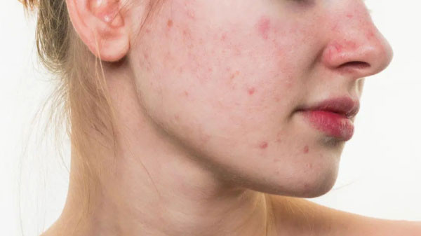 Làn da hỗn hợp thiếu ẩm và thừa dầu dễ gặp vấn đề trong mùa đông