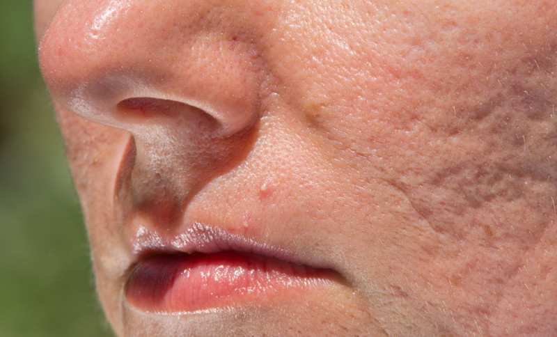 Mô tả: Sẹo rỗ là các vết lõm trên da do tổn thương sâu ở lớp biểu bì, ảnh hưởng đến thẩm mỹ