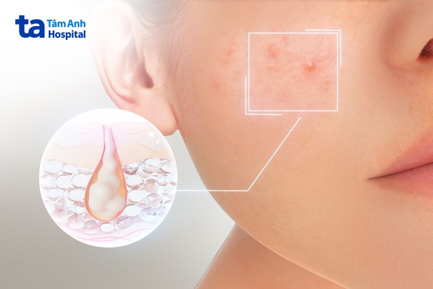 Quy trình peel da trị mụn bọc giúp loại bỏ tế bào chết và giảm sẹo thâm