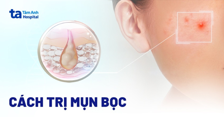 Tổng quan các phương pháp cách trị mụn bọc hiệu quả