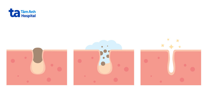 Tổng quan quá trình chăm sóc và loại bỏ mụn cám để có làn da khỏe mạnh