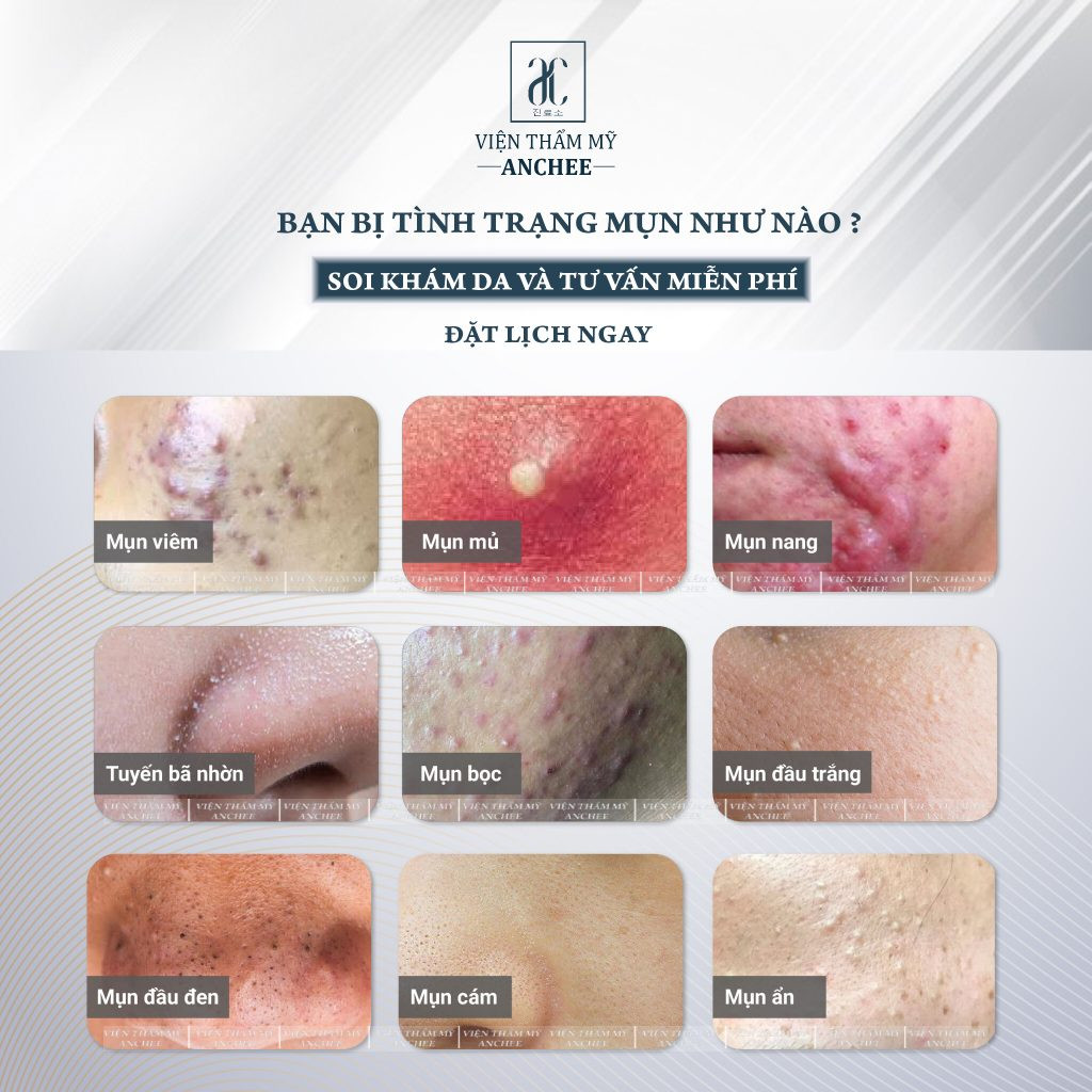 ảnh cận cảnh tình trạng mụn ẩn dưới da cần điều trị chuyên sâu, thường thấy trong các video nặn mụn ở spa