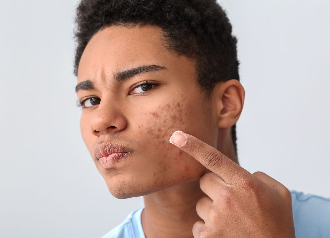 Các phương pháp và liệu trình trị mụn ở spa hiệu quả