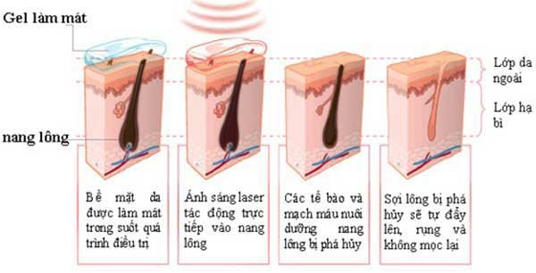 Cách thức vận hành triệt lông diode laser