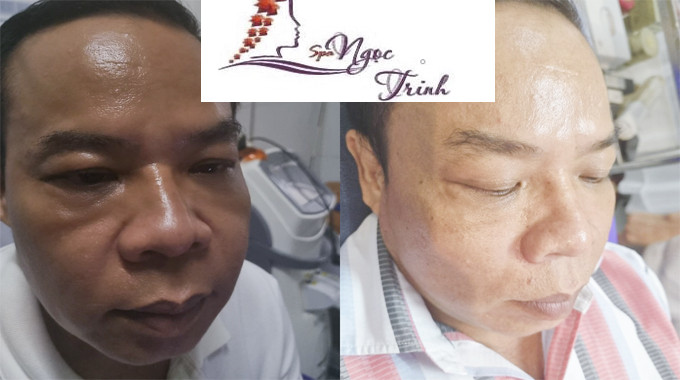 Chăm sóc da mặt chuyên sâu cho nam giới tại Clair Center