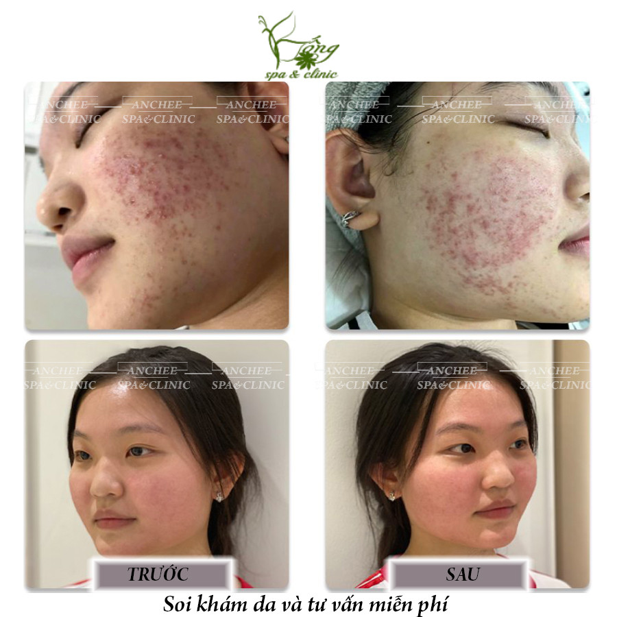 Chương trình ưu đãi và voucher cho dịch vụ nặn mụn tại spa