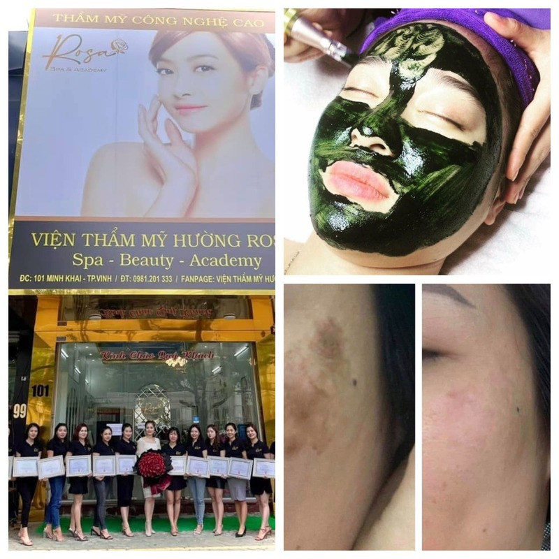 Chuyên viên Rosa Spa thực hiện liệu trình cấy tảo mix HA & Collagen tươi cho khách hàng, giúp da trắng sáng và căng bóng tại spa ở thành phố Vinh