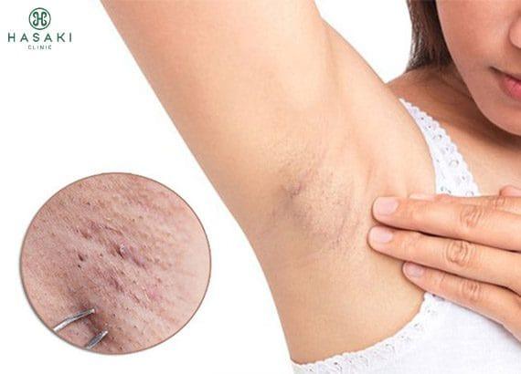 Quy trình triệt lông vĩnh viễn tại Hasaki Clinic, một spa triệt lông uy tín tại TPHCM