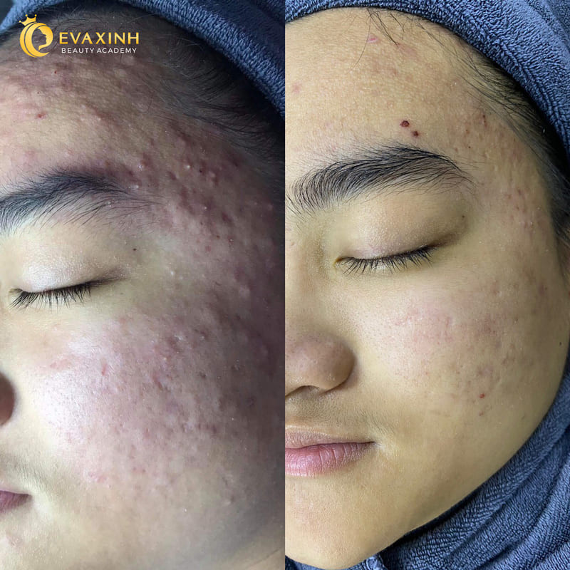 Giữ da sạch sẽ sau khi nặn mụn ở spa để tránh nhiễm trùng và hỗ trợ phục hồi da