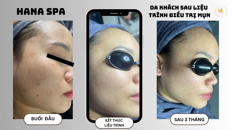 Hana Spa là một spa ở thành phố Vinh uy tín, chuyên trị mụn và chăm sóc da chuyên sâu với mức giá bình dân, được nhiều khách hàng tin tưởng.
