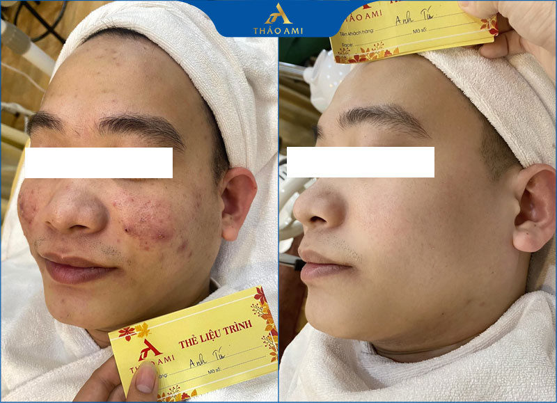 Hiệu quả rõ rệt sau khi trị mụn thâm tại Clair Center Hà Nội