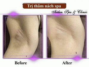 Hiệu quả trị thâm nách spa
