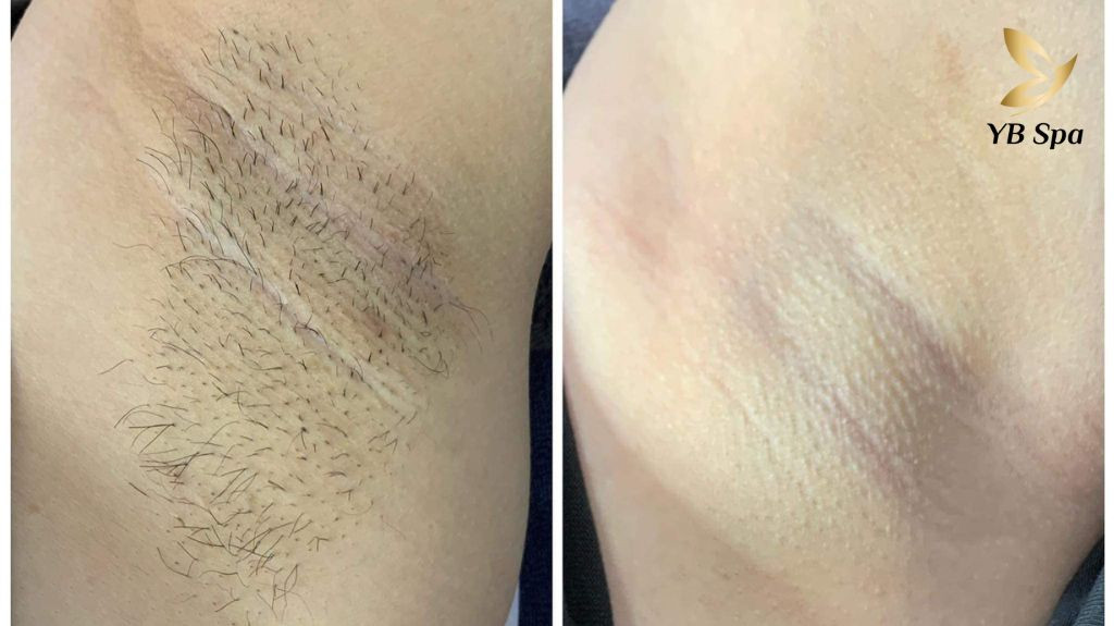 Hiệu quả triệt lông nách vĩnh viễn giúp da sáng mịn tự tin