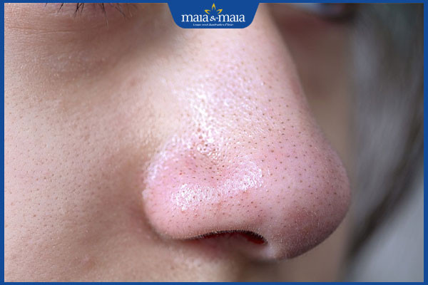 Hình ảnh cận cảnh mụn đầu đen trên mũi, loại mụn thường được khuyên lấy nhân ở spa