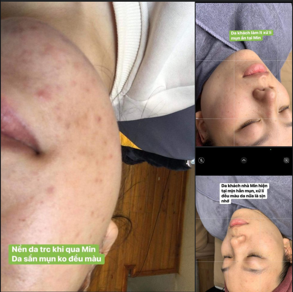 Hình ảnh cận cảnh quy trình điều trị mụn chuyên sâu tại spa