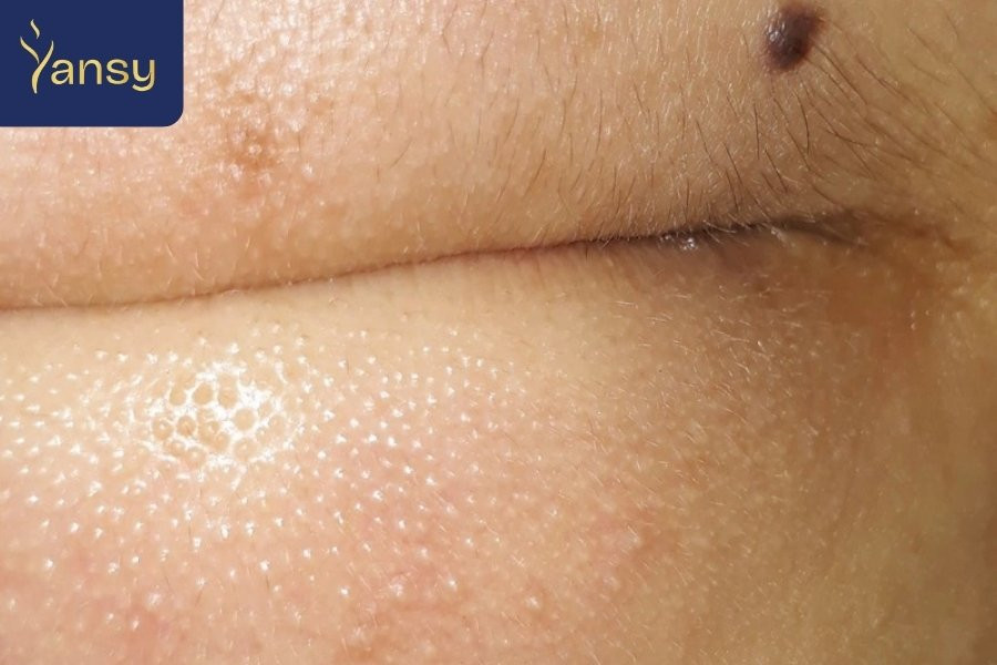 Hình ảnh minh họa mụn ẩn dưới da cần được điều trị tại spa uy tín