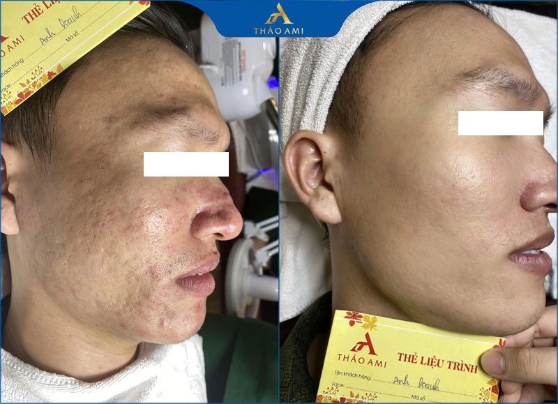 Kết quả sau liệu trình trị mụn thâm và sẹo rỗ tại Clair Center