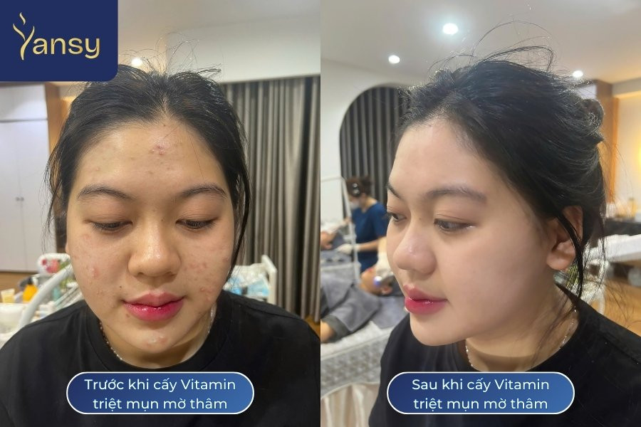 Khách hàng cải thiện rõ rệt sau liệu trình cấy vitamin triệt mụn tại spa uy tín