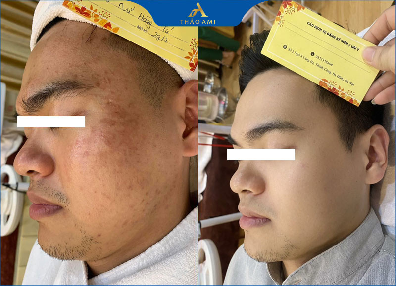 Khách hàng hài lòng với kết quả trị mụn thâm tại Clair Center Hà Nội