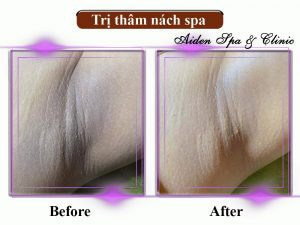 Khách hàng thư giãn khi trị thâm nách spa giá bao nhiêu