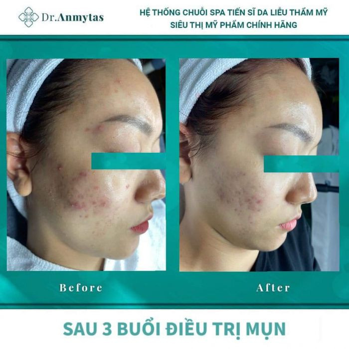 Không gian thư giãn và điều trị mụn chuyên nghiệp tại MoonLight Spa Nguyễn Tất Thành
