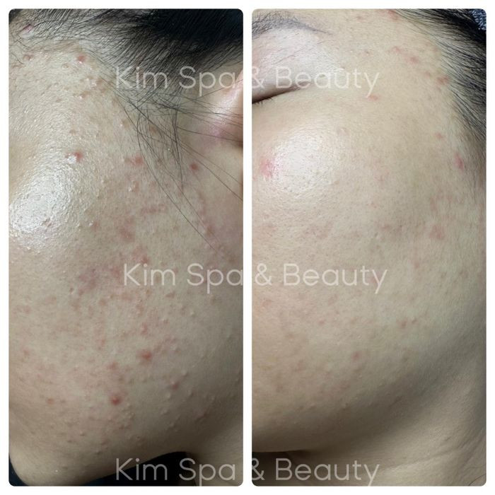 Kim Spa &amp; Beauty - địa chỉ trị mụn uy tín với công nghệ tiên tiến