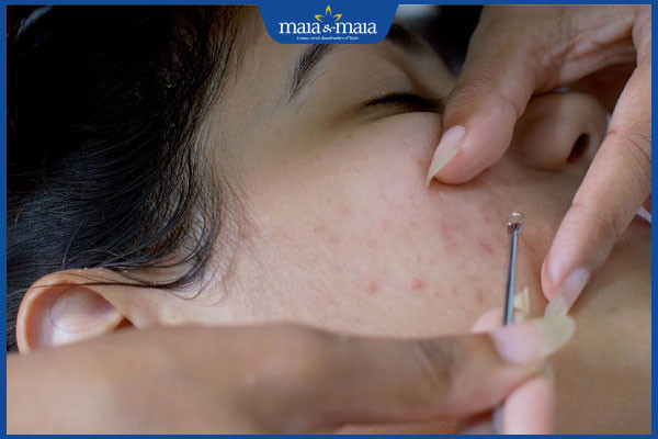 Kỹ thuật viên chuyên nghiệp thực hiện quy trình lấy nhân mụn ở spa an toàn