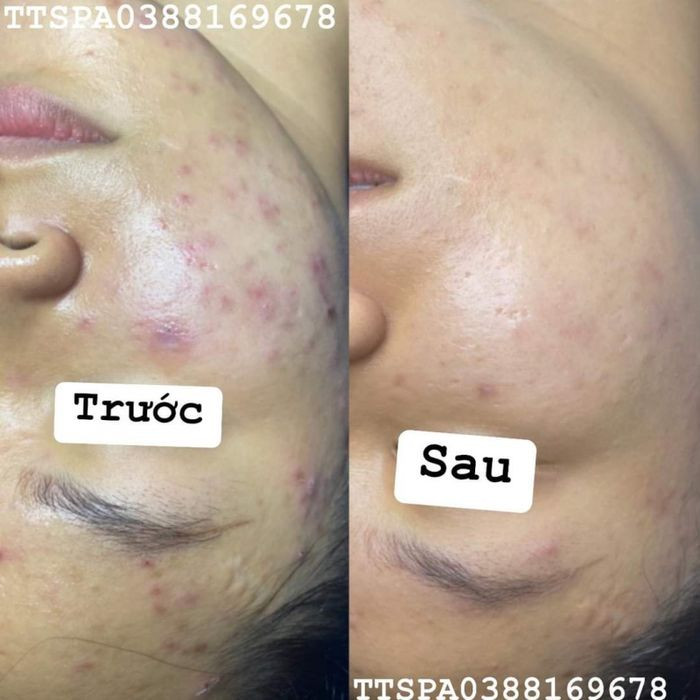 Kỹ thuật viên TT Spa thực hiện liệu trình trị mụn chuyên nghiệp