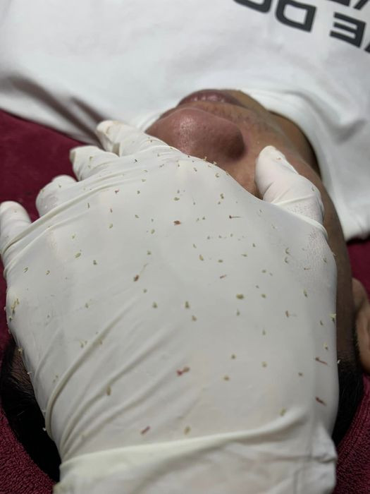 Liệu trình chăm sóc da trị mụn chuyên sâu tại Cỏ Đá Spa