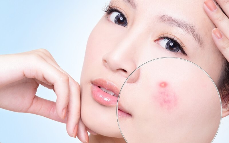 Mức độ nghiêm trọng của mụn và tình trạng da ảnh hưởng lớn đến bảng giá spa trị mụn