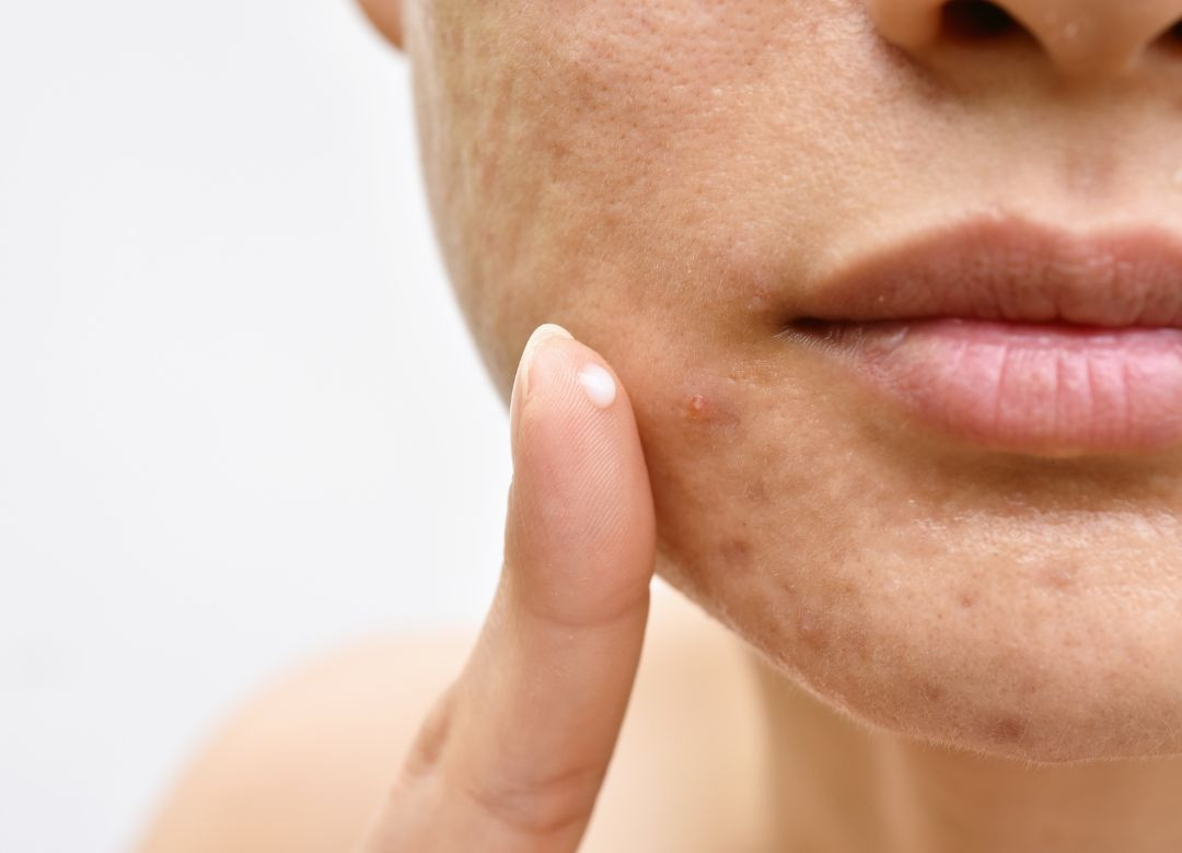 Nếu chỉ có vài nốt mụn nhỏ, việc dùng kem đặc trị tại nhà có thể là đủ